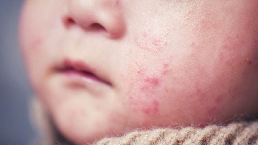 গোপালগঞ্জে হামের ভয়াবহ প্রকোপ: ১১৩ শিশু আক্রান্ত, ল্যাব সংকটে শনাক্তে বিলম্ব